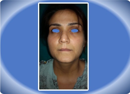 LOWER LIP ENHANCEMENT
